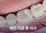 레진 치료 후 식사 가이드와 건강한 유지를 위한 주의사항