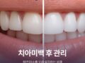 치아미백 후 관리, 하얀 미소를 오래 유지하는 비결