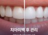 치아미백 후 관리, 하얀 미소를 오래 유지하는 비결