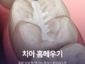 우리 아이 첫 영구치 지키는'치아 홈메우기' 체크리스트