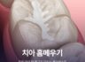 우리 아이 첫 영구치 지키는'치아 홈메우기' 체크리스트