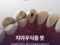 치아우식증 뜻, 방치하면 커지는 충치 단계별 증상 알아보기