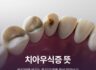 치아우식증 뜻, 방치하면 커지는 충치 단계별 증상 알아보기