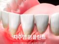 치주염이 있어도 임플란트가 가능할까? 안전한 임플란트 식립을 위한 주의사항