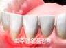 치주염이 있어도 임플란트가 가능할까? 안전한 임플란트 식립을 위한 주의사항