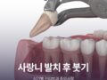 사랑니 발치 후 붓기, 시기별 관리법과 주의사항