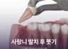 사랑니 발치 후 붓기, 시기별 관리법과 주의사항