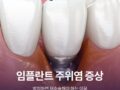 임플란트 주위염 증상 방치하면 재수술해야 하는 이유