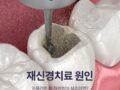 크라운 내부에 또 염증이? 주요 재신경치료 원인과 위험 신호