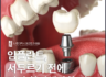 부평시장역 치과 발치 후 임플란트 서두르기 전에 확인하세요