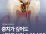 [검단사거리치과] 같은 충치인데 치과마다 신경치료 여부가 달랐다면?